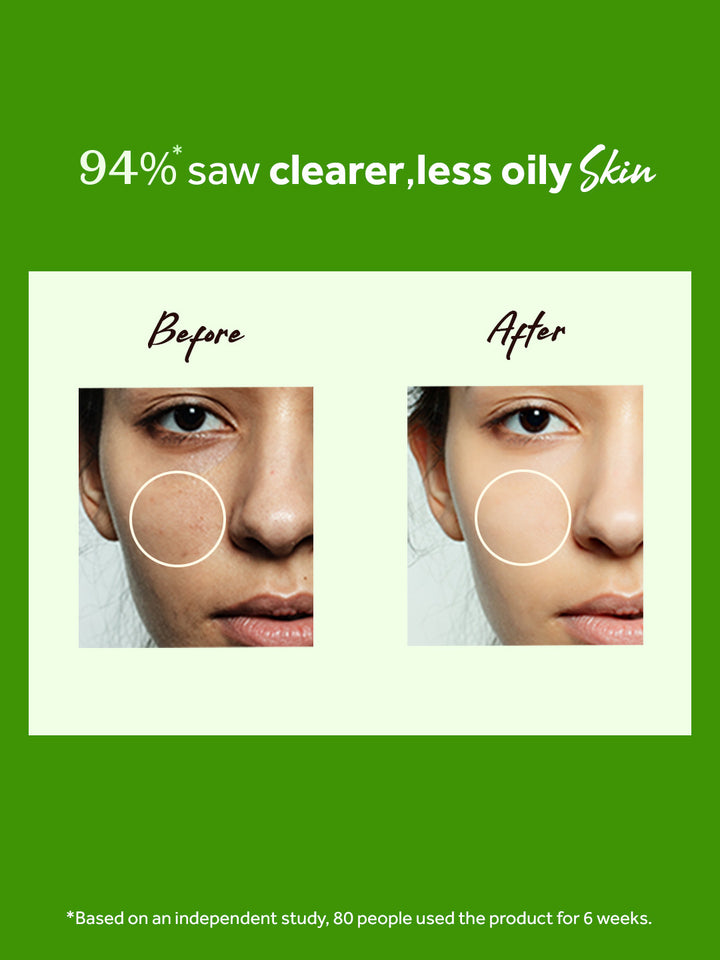 Atulya Tea Tree Anti Acne Facial Mist Toner - 150ml